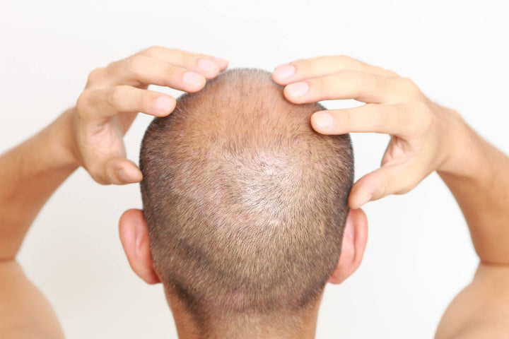 Scalp ringworm with scale and broken hairs requiring oral treatment