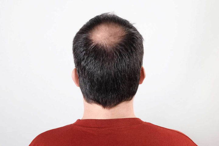 Smooth round alopecia areata patch examined with dermoscopy