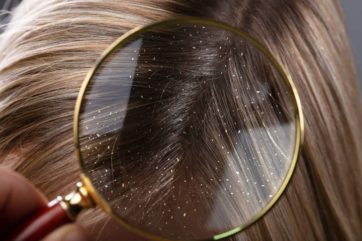 Dandruff scale and irritated scalp with gentle treatment guidance