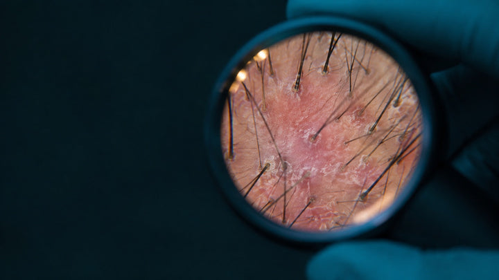 Dermatoscope view showing perifollicular redness and scale on the scalp