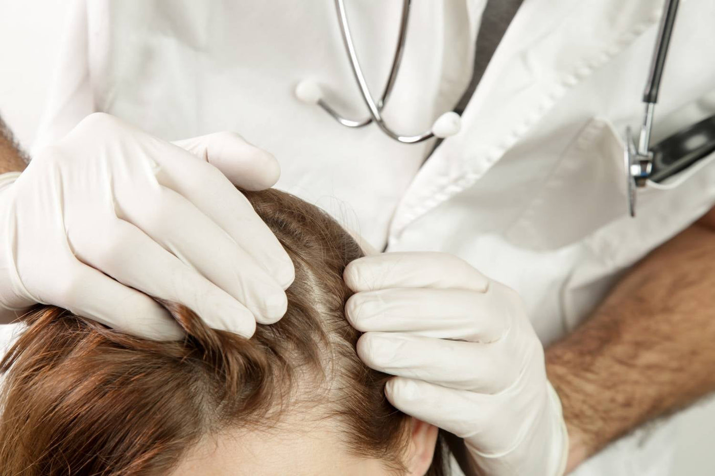 Scalp psoriasis plaque with scale and redness under hair