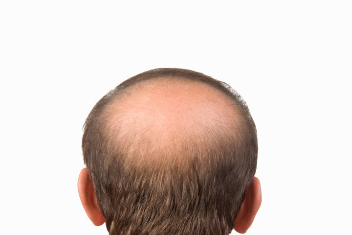 Family history and scalp patterns related to genetic hair loss