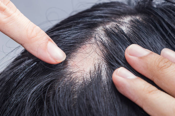 Medical Conditions That Can Cause Hair Loss