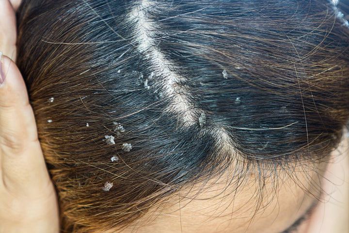 Seborrheic Dermatitis and Hair Loss: What to Know