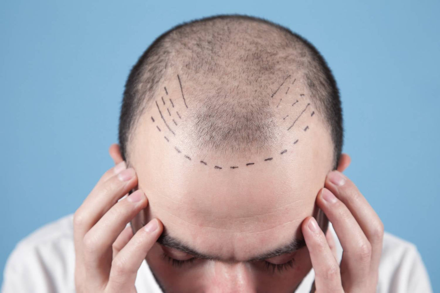 Hair transplant consultation assessing donor and recipient areas